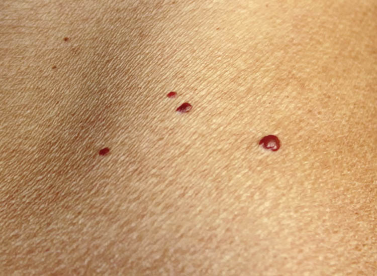 Blood Spots On Skin