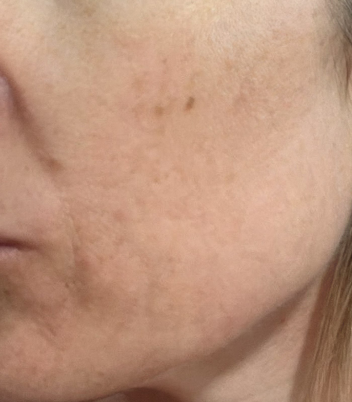 Skin consultation transformation one - after