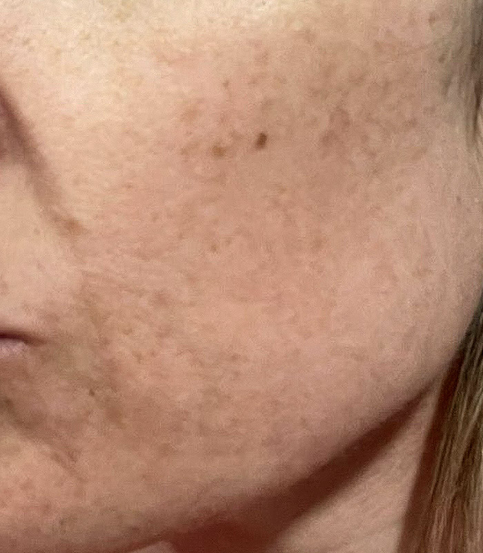 Skin consultation transformation one - before